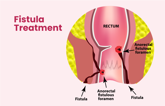 Fitsula