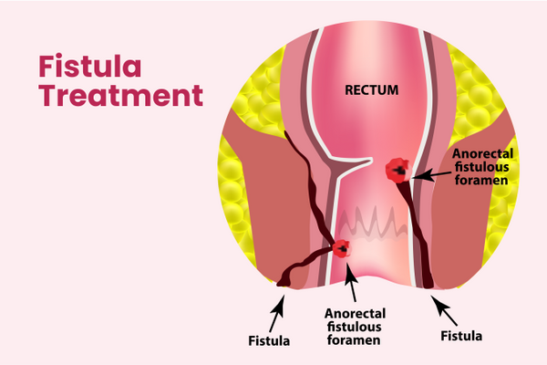 Ayurvedic Fistula Treatment: How Shree Ayurveda Can Help Heal Fistula Naturally